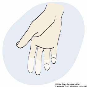 Raynaud s Syndrome Symptoms Numbness and tingling in the fingers during vibration exposure; may continue after exposure has been discontinued Blanching