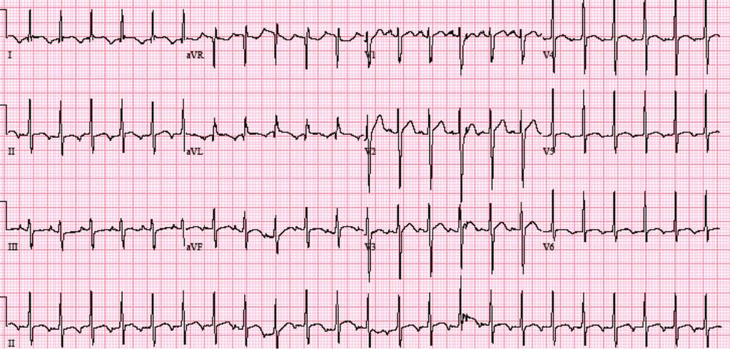 2 Case Reports in Medicine Figure 1: 12 lead ECG on presentation. Narrow complex tachycardia with HR of 139 and nonspecific T wave abnormalities. Figure 2: 12 lead ECG.