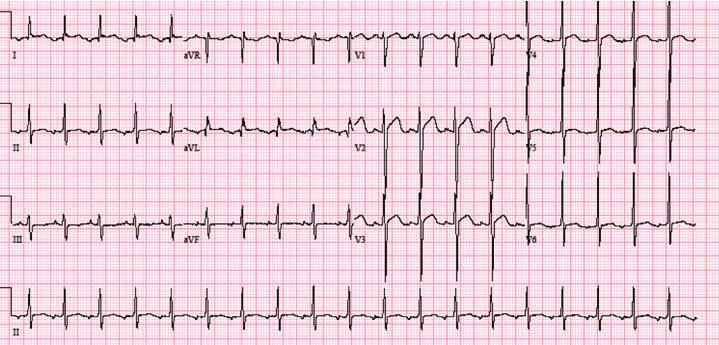 P waves are inverted in lead II and AVL, while the P waves were upright in III and AVF, suggesting the possibility of ectopic atrial tachycardia, most likely originating from the left side.