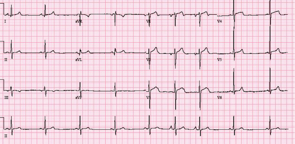 Case Reports in Medicine 3 Figure 3: 12 lead ECG after ablation of atrial tachycardia showed sinus