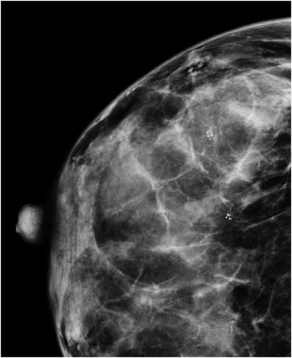 Fig. 9: Two different cluster of microcalcifications on outer quadrant of the right breast.