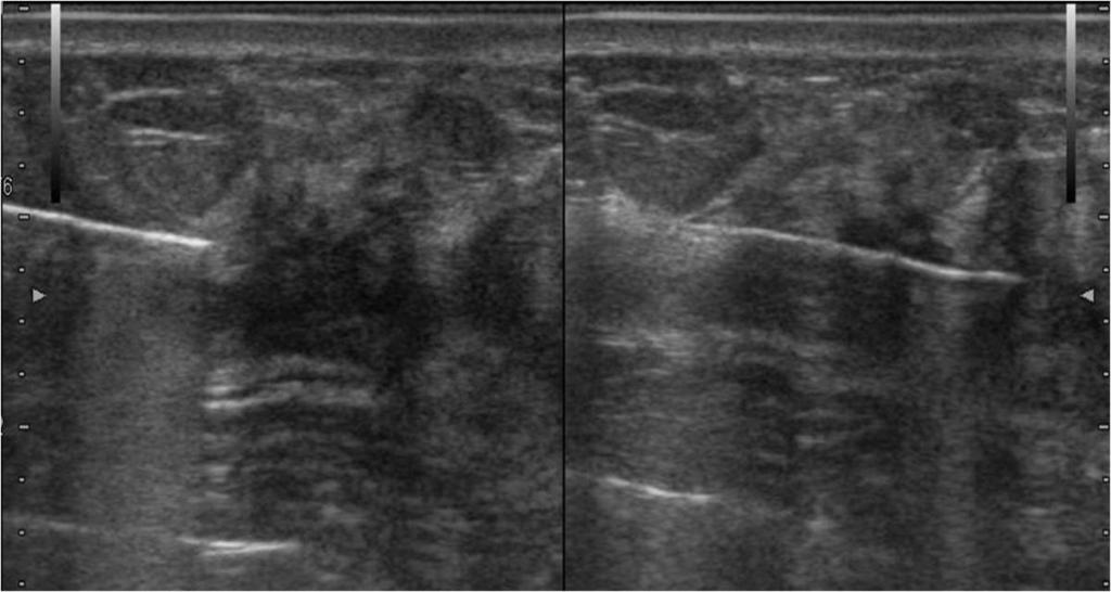 Fig. 13: Trucut biopsy of this ill-defined lesion revealed ADH.