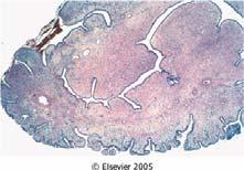 Diseases of the Cervix Chronic Cervicitis Chronic Cervicitis Cervical Epithelial Intraepithelial Neoplasia Cervical erosion Cervical Nabothian cyst Endocervical polyp Pathology for 7yr (DH) 9