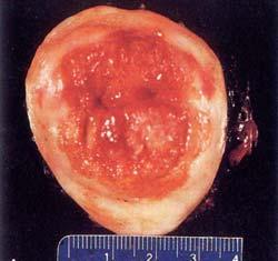 (DH) 20 cervical carcinoma: eroding pattern Pathology for 7yr