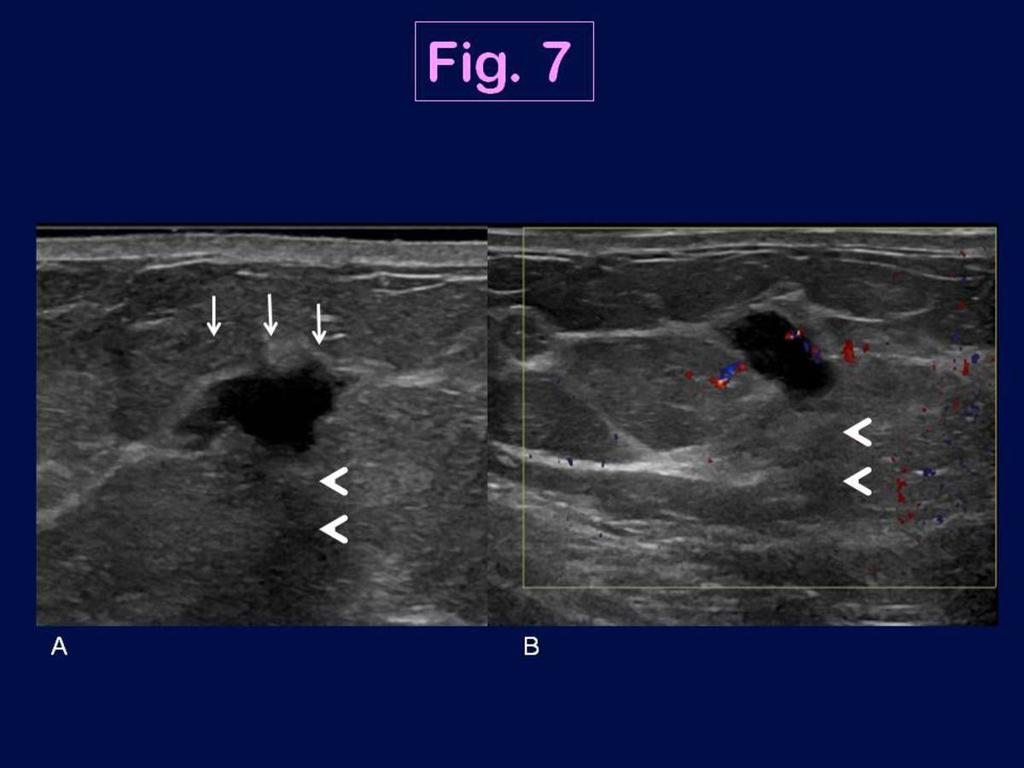 Fig. 7: Ultrasound features of the triple negative breast cancer in a 57 year-old woman in the right breast (IDC, high grade): US images show a markedly hypoechoic mass (A) with