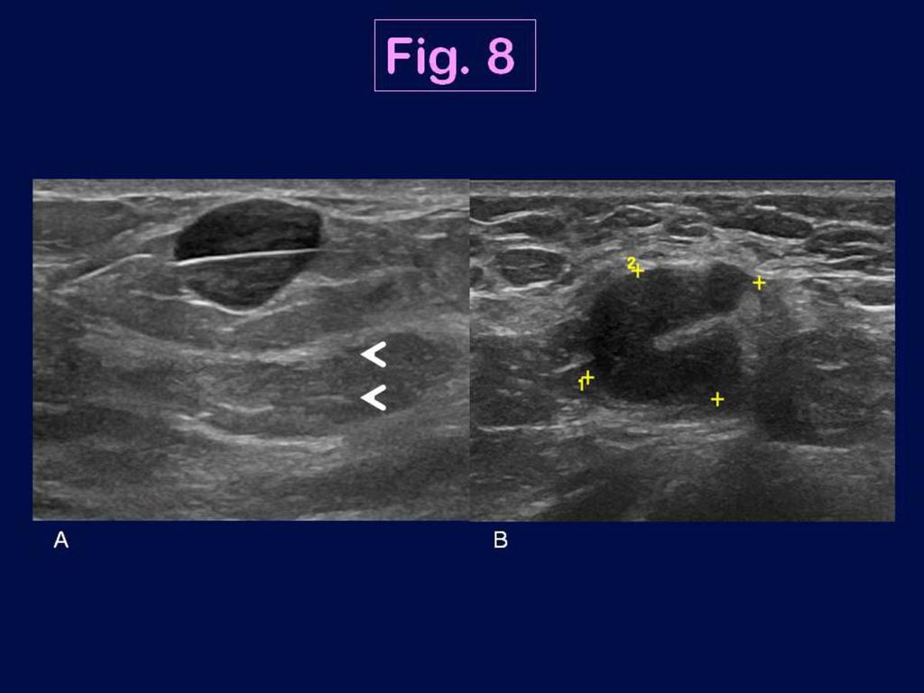 Fig. 8: Ultrasound features of the triple negative breast cancer shown in Fig.
