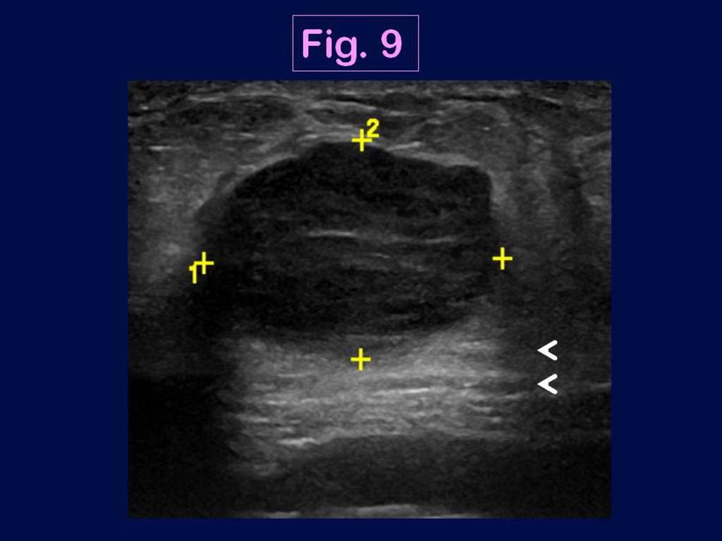 Fig. 9: Ultrasound features of the triple negative breast cancer in a 41 year-old woman in the right breast (medullary carcinoma, high grade): US