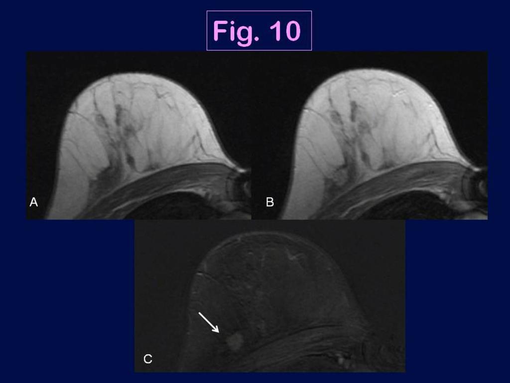 Fig. 10: MRI appearance of the triple negative breast cancer in a 58 year-old woman in the right breast (IDC, moderate grade): axial pre-contrast (A) and early enhanced 3D T1-weighted images (B) with