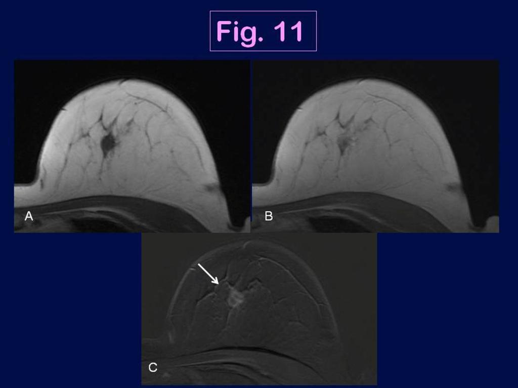 Fig. 11: MRI appearance of the triple negative breast cancer in a 68 year-old woman in the left breast (IDC, high grade): axial pre-contrast (A) and early enhanced 3D T1- weighted images (B) with
