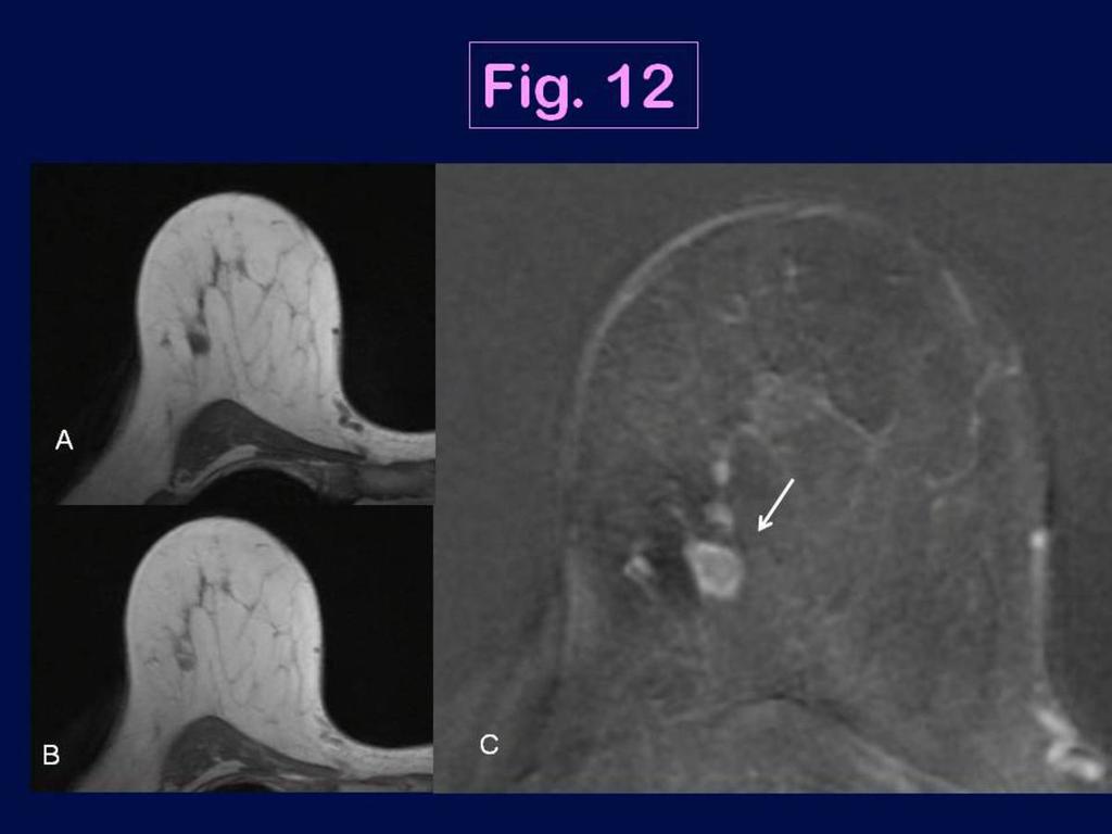 Fig. 12: MRI appearance of the triple negative breast cancer in a 72 year-old woman in the right breast (medullary carcinoma, high grade): axial pre-contrast (A) and early enhanced 3D T1-weighted