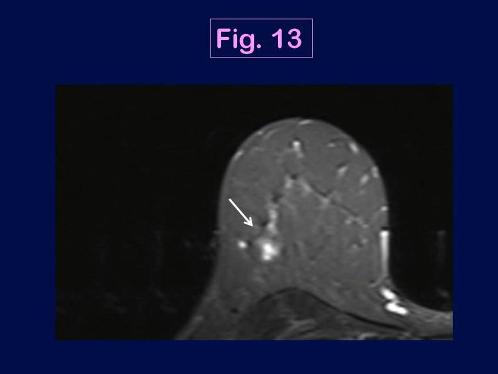 Fig. 13: MRI appearance of the triple negative breast cancer shown in Fig.