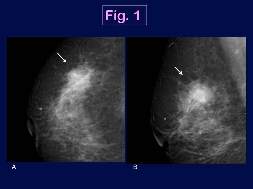 Fig. 1: Triple negative breast cancer in a 74 year-old woman with palpable nodule in right breast (IDC, high grade).