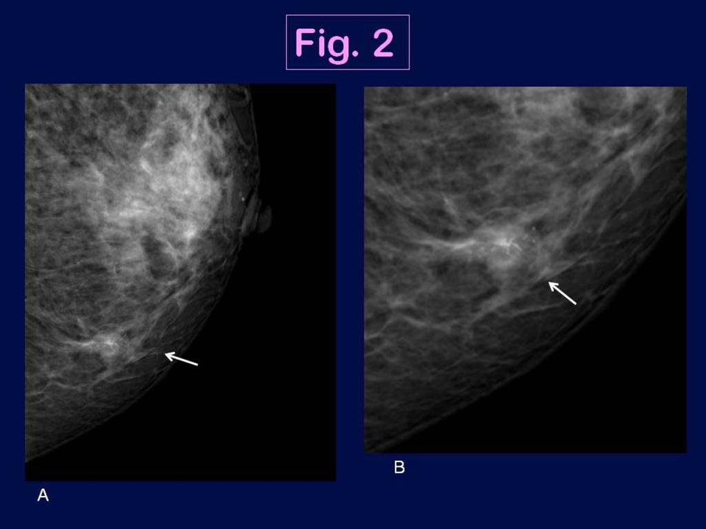 Fig. 2: Triple negative breast cancer in a 54 year-old woman in the left breast (IDC, high grade).