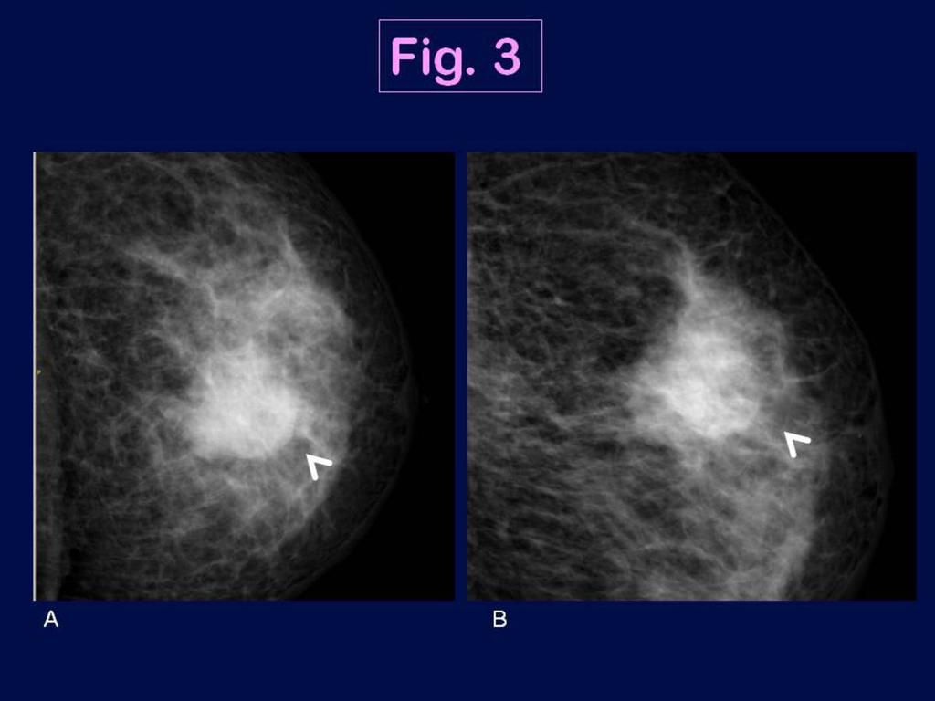 Fig. 3: Triple negative breast cancer in a 77 year-old woman with palpable nodule in the left breast (IDC, high grade).
