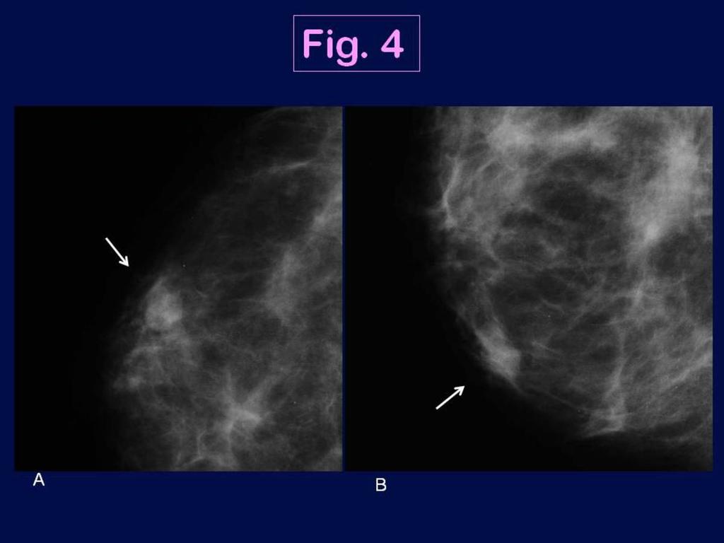 Fig. 4: Triple negative breast cancer in a 50 year-old woman in the right breast (medullary carcinoma, high grade).
