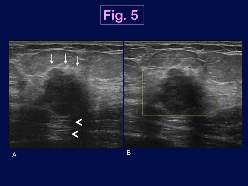 Fig. 5: Ultrasound features of the triple negative breast cancer shown in Fig.