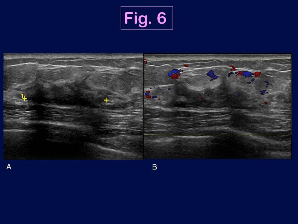 Fig. 6: Ultrasound features of a triple negative breast cancer in a 64 year-old woman in the left breast (invasive lobular carcinoma, moderate grade): US images show an
