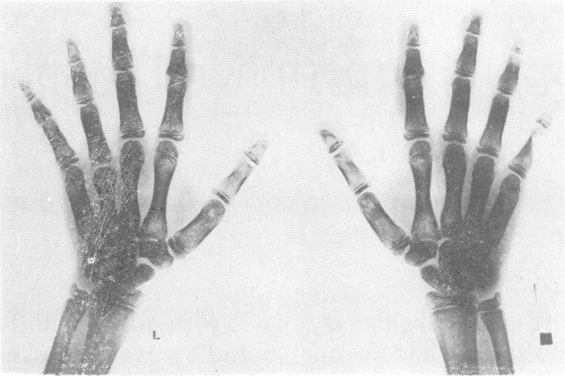 118 had brachydactyly of the hands and feet and externa rotation contracture and restricted movement in both hip joints. Case 5 (1.1) The mother of case 4 died at the age of 81.