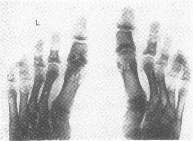 His height was 154 cm and weight was 70 kg. The metatarsals were of unequal length as were the metacarpals, and he had limited movement of the hips with pain.