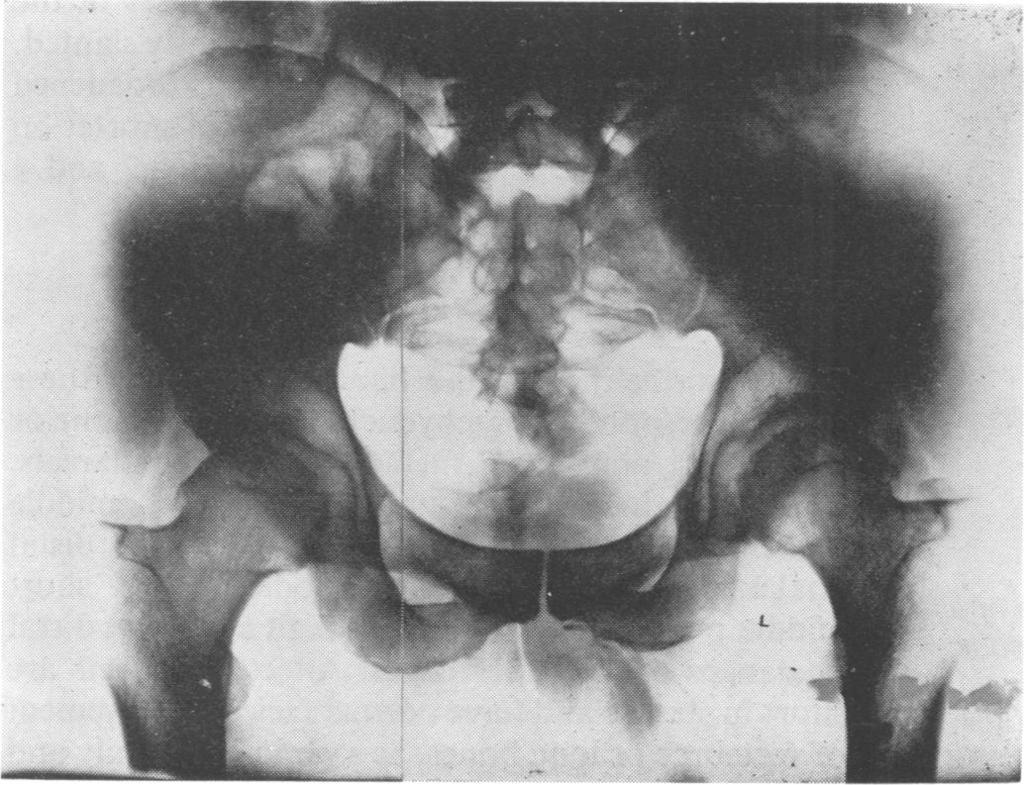 The most severe changes in these three patients were seen in the lumbar region, showing the so-called 'fish vertebra' pattern (fig 5a-c).
