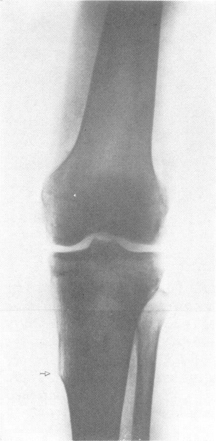 Anteroposterior radiograph of lefi knee joint.