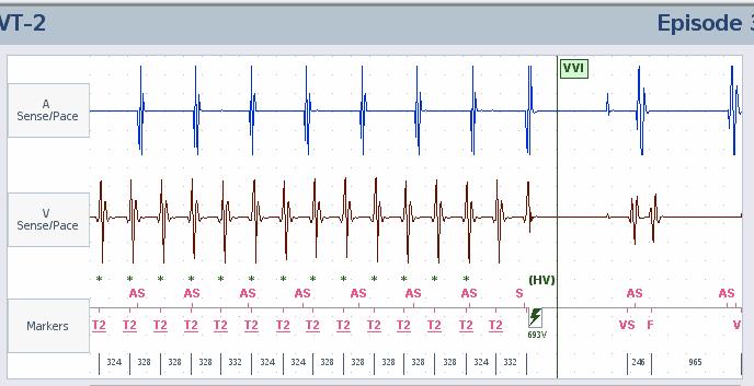 Detection Proper rhythm detection is dependent upon: Accurate sensing: Undersensing (signal dropout) Oversensing (double-counting or T-wave sensing) This will result in incorrect interval measurement