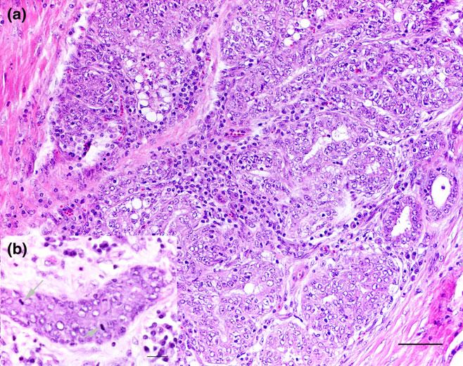 Mammary tuberculous granulomas with caseous necrosis. H&E. Scale bar = 300 lm Fig. 5. Ki-67 expression in mammary tumour cells, including mitosis.