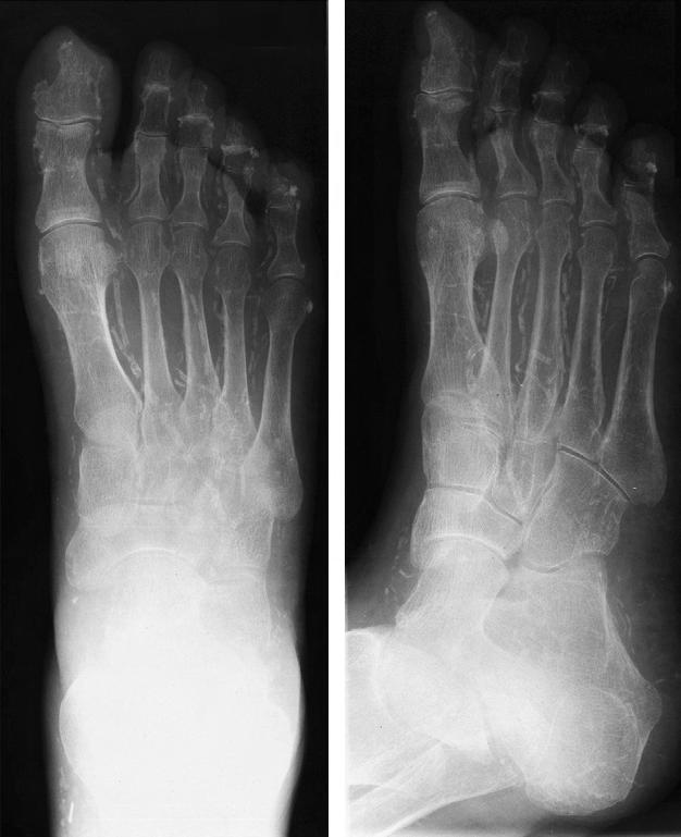 778 Boulton Fig. 2. Radiograph of the foot of a neuropathic diabetic patient showing extensive medial arterial calcification down to the digital vessels.