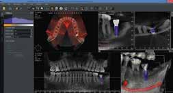You can also import STL files from your laboratory and your dental impression camera.