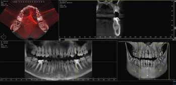 maxillary Left / right premolar