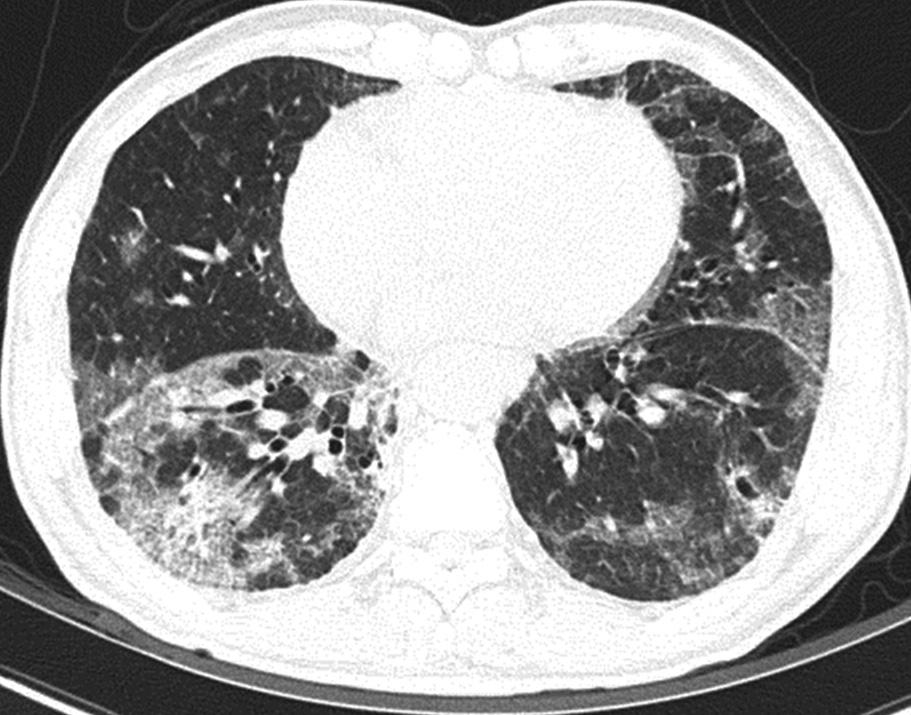 Sequential CT Findings of IgG4-Related Lung Disease of both upper lobes. The largest one was measured to be 32 mm in size.