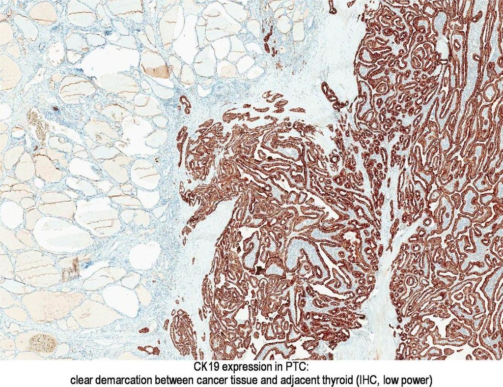 Cytokeratin in papillary thyroid carcinoma http://www.pathpedia.