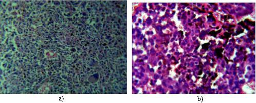 HMB45 in melanoma Malignant mucosal melanoma (MMM) is a neural crest derived neoplasm originating from melanocytes and demonstrating melanocytic differentiation.