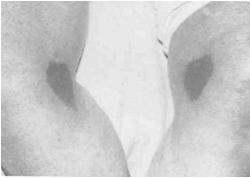 serum filled blister Adipose (fat) is not visible and deeper tissues are not visible Pressure Injury