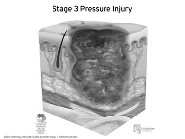 Pressure Injury Stage 3 Full thickness skin loss Adipose (fat) is visible in the ulcer Granulation tissue and epibole (rolled wound edges) are often present Slough and/or eschar may be visible