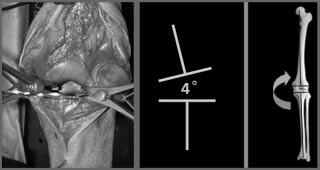 A Non-CT Based Total Knee Arthroplasty System 411 4 Intraoperative Planning and Soft-Tissue Balancing The registration of the patient s anatomy allows alignment of the component according to the
