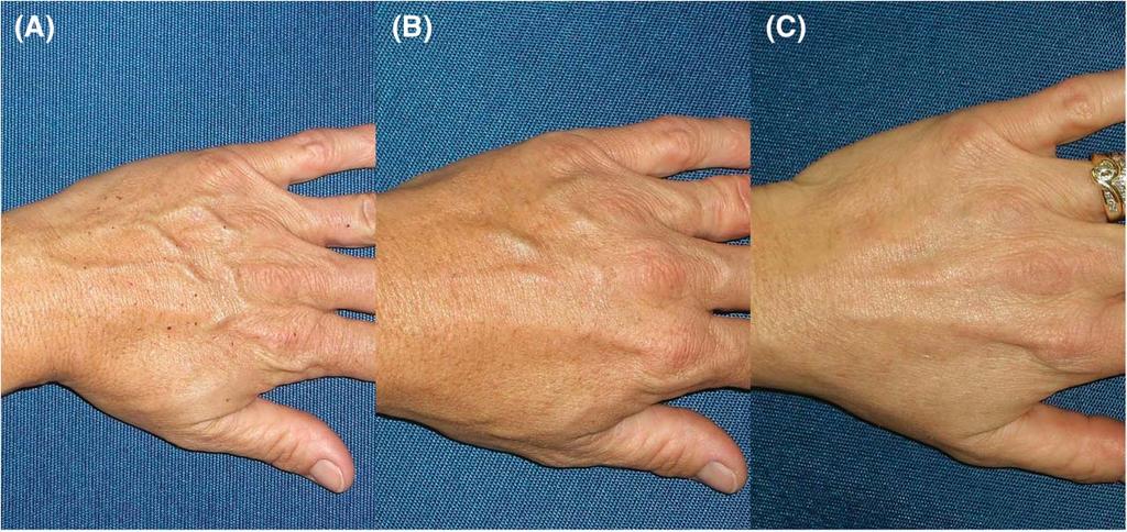 FOAM SCLEROTHERAPY FOR RETICULAR VEINS Figure 2. Left dorsal hand veins after 2 sessions (2 months apart) using 0.5% STS. (A) Before treatment. (B) After Session 1. (C) After Session 2.