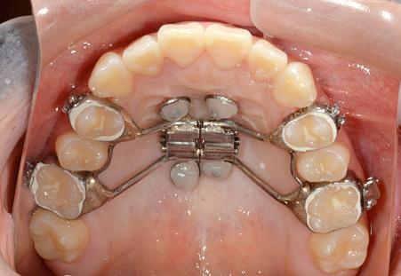 B. Method of study 1. Clinical application of MARPE The MARPE was modified with 4-banded (supported by bilateral maxillary first premolars and first molars) conventional hyrax type RPE.