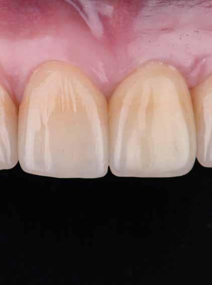 ACCREDITATION ESSENTIALS Integrating Natural Hard and Soft Tissue An Implant-Supported Restoration in the Esthetic Zone Somkiat Aimplee, DDS, MSc The successful replacement of anterior teeth with