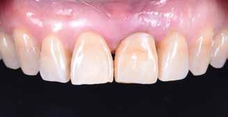 The assembly was unscrewed and the subgingival emergence profile was modified by carefully adding composite resin (Filtek Z350, 3M ESPE) so as not to overcontour the subgingival area, which can cause
