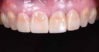 4,5 The patient had several more appointments to groom the tissues into the desired shape by modifying the subgingival emergence profile and changing contours and contact points of the provisional