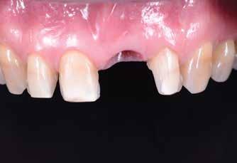 The veneer restorations were bonded using an adhesive (Single Bond, 3M ESPE) and a light-cured resin cement (RelyX veneer cement).