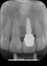 stability around the implant and complete integration of restorations