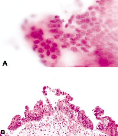 FNA of Pancreatic Tumors/Recine et al. 95 FIGURE 1. High-grade mucinous cystic neoplasm.