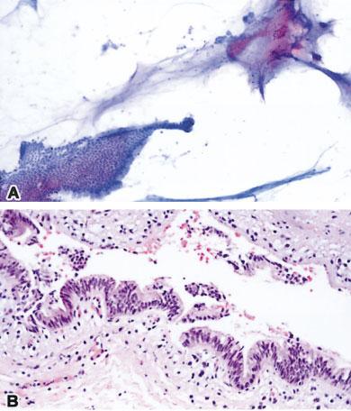 (B) Corresponding tissue section shows a cystic space lined by mucinous epithelium demonstrating marked atypia and features of in situ carcinoma. FIGURE 2. Low-grade mucinous cystic neoplasm.