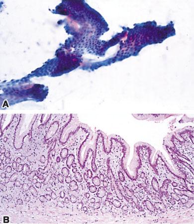 (B) Corresponding tissue section showing a papillary proliferation of bland columnar cells. DISCUSSION The management of pancreatic mucinous tumors depends on the specific type of neoplasm.