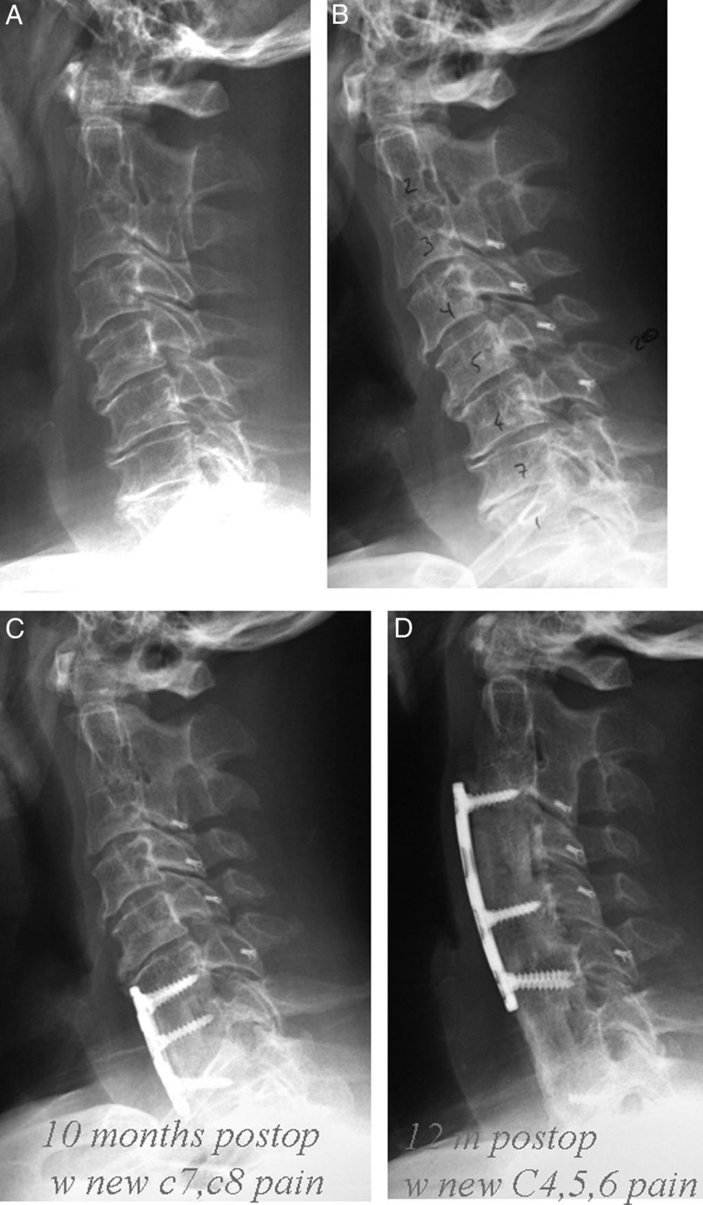 2764 Spine Volume 34 Number 25 2009 Figure 2. Case 3. A, Shows a prelaminoplasty lateral cervical spine radiograph. B, Shows open-door laminoplasty held opened by suture anchors.