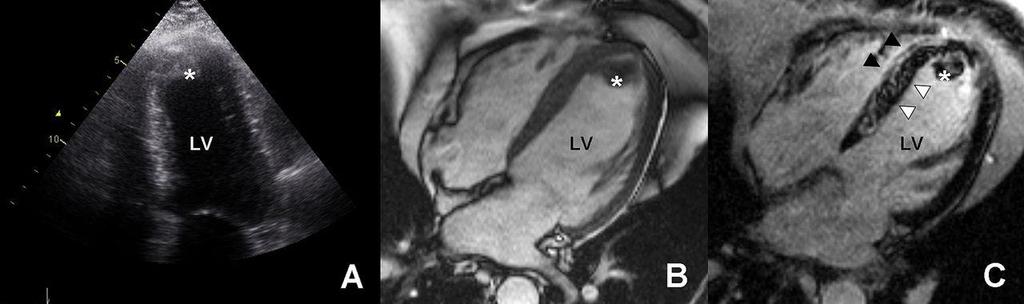 Left ventricular (LV) thrombus formation on delayed gadolinium contrast cardiac