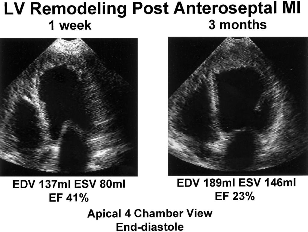 Left ventricular (LV) remodeling after transmural anteroseptal myocardial infarction (MI): 2D