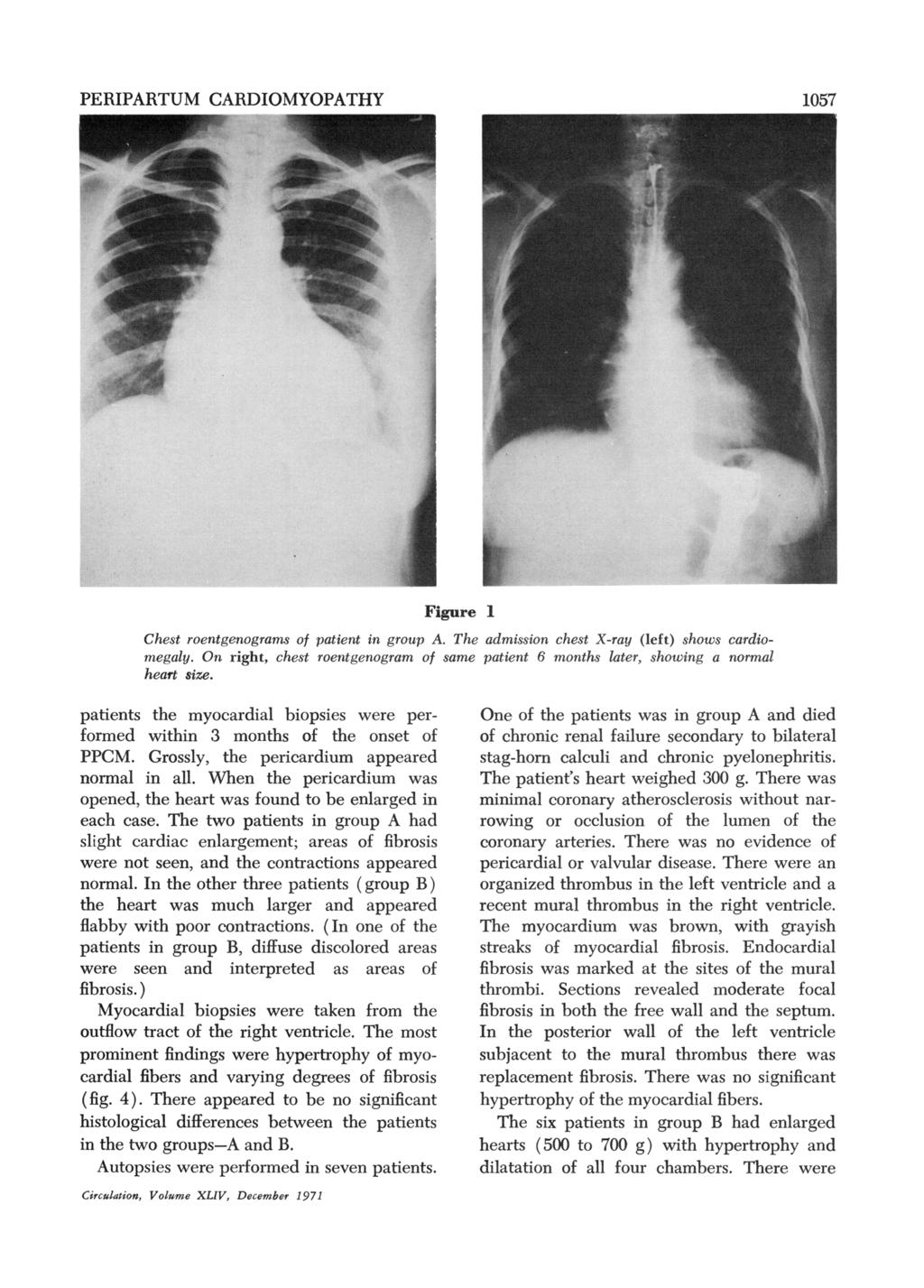 PERIPARTUM CARDIOMYOPATHY 57 Figure Chest roentgenograns of patient in group A. The admission chest X-ray (left) shows cardiomegaly.